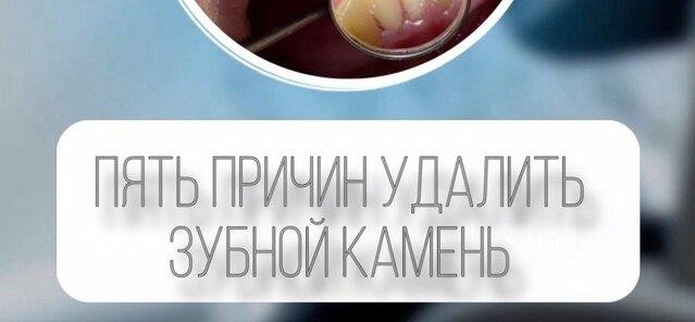«Пять причин», что зубной камень вам не нужен✖️