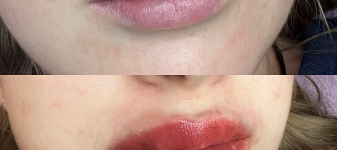 Увеличение губ от 8000₽ 💋