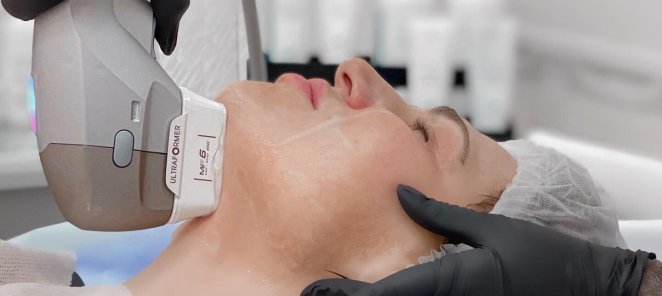 SMAS-лифтинг Ultaformer лица + Lumecca !