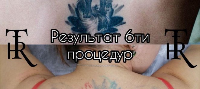 Скидка до -20% на удаление тату