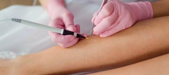 Электроэпиляция 700 руб за 40 минут