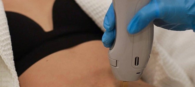 Лазерная эпиляция всё тело и лицо без ограничений 14 990 р.