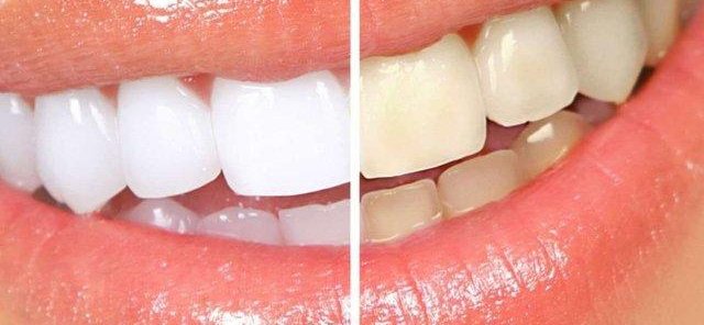 ОТБЕЛИВАНИЕ СИСТЕМОЙ AMAZING WHITE 12 000р. вместо 18 000р.