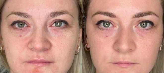 Омоложение FlaxSculpt 3000 руб