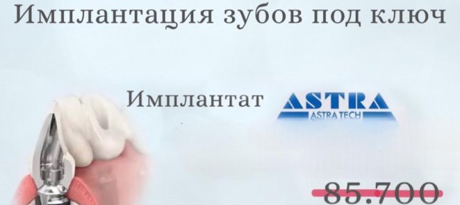 Имплантация зубов под ключ ASTRA