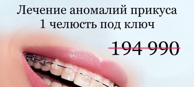 БРЕКЕТЫ ПОД КЛЮЧ