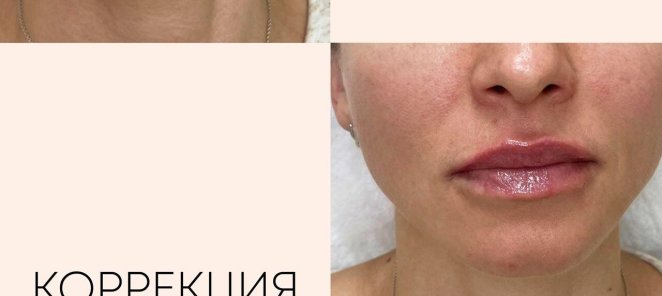 Идеальная коррекция губ Hyon Max 💯