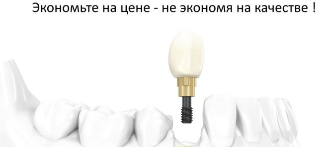 Имплантация зубов с гарантией