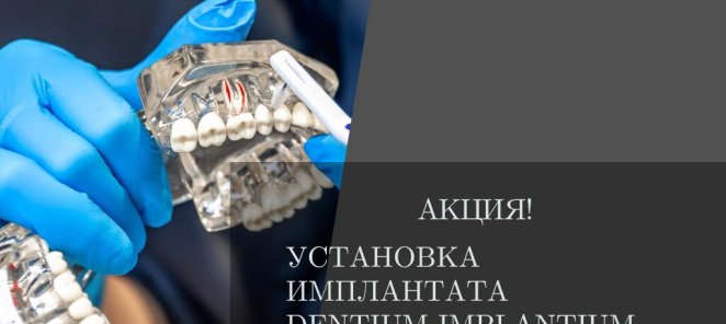 Установка имплантата со скидкой