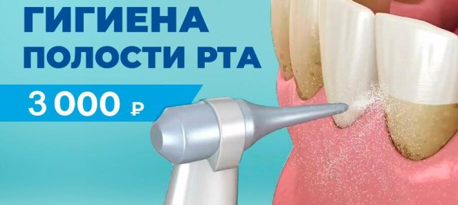 Профессиональная чистка зубов