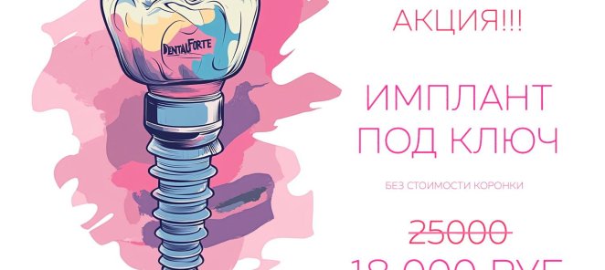 Имплантация со скидкой