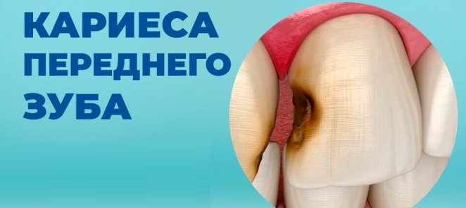 Лечение кариеса со скидкой 50%