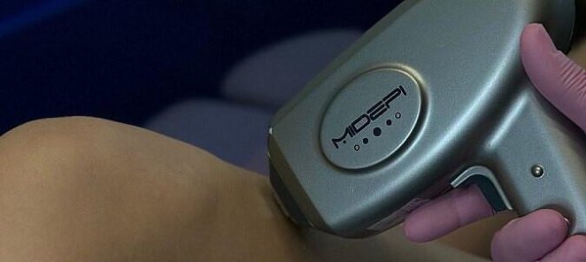 Лазерная эпиляция руки на аппарате MIDEPI со скидкой 20%