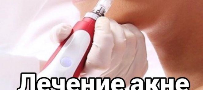 Лечение акне без боли