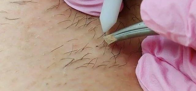 Электроэпиляция-20% на первый визит
