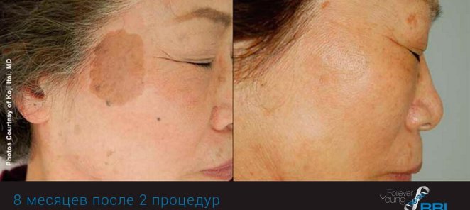 Фототерапия BBL – убрать пигментацию со скидкой 20%
