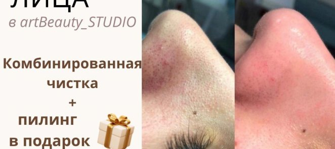 Пилинг в подарок