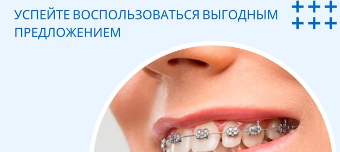Брекеты DAMON Q в рассрочку