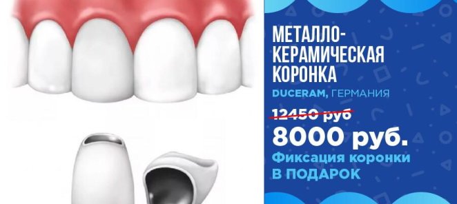 Металлокерамическая коронка