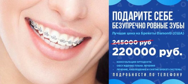 Подарите себе ровные зубы с брекетами