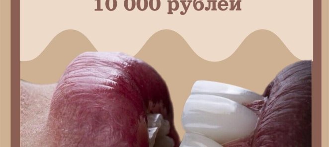Отбеливание Amazing White 10 000