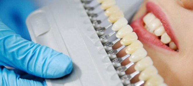 Отбеливание зубов в стоматологической клинике GIONIX