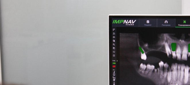 ВПЕРВЫЕ В Воронеже! Навигационная хирургия IMPNAV