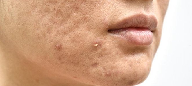 Лазерная шлифовка лица эрбиевым лазером ASCLEPION DERMABLATE