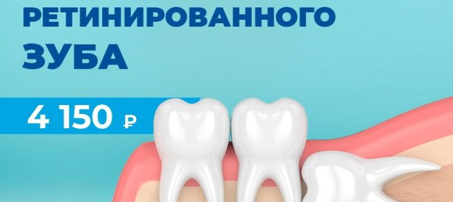 Удаление ретированного зуба