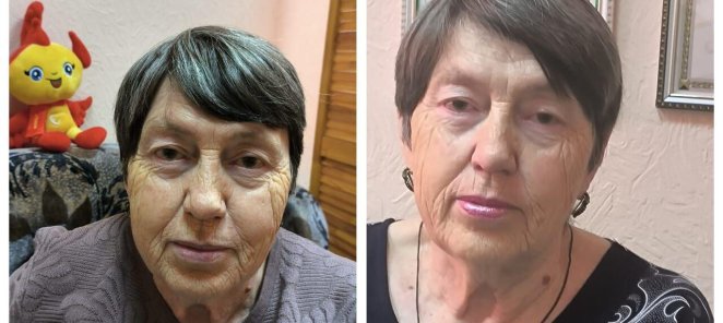 Первая процедура с выгодой 50%