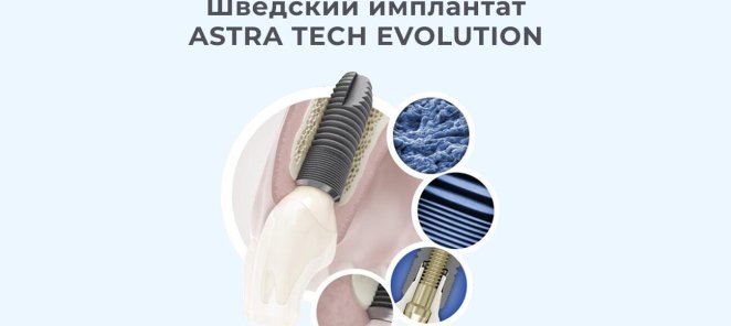 Акция на имплантат Astra Evolution (Швеция) за 43990 руб.
