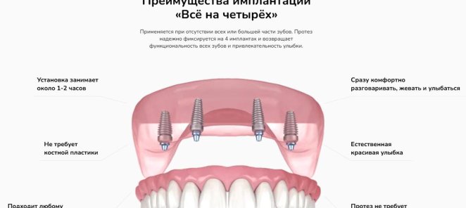 Имплантация «Всё на четырёх» — новая улыбка за 358 800 ₽