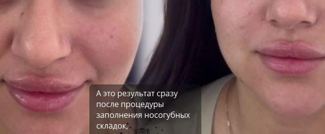 Результат после процедуры заполнения носогубных складок