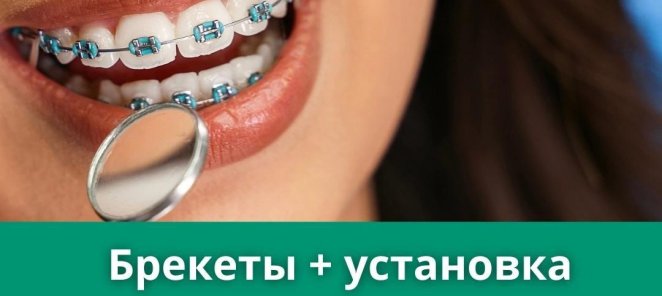Брекеты+ установка 29900руб🎁