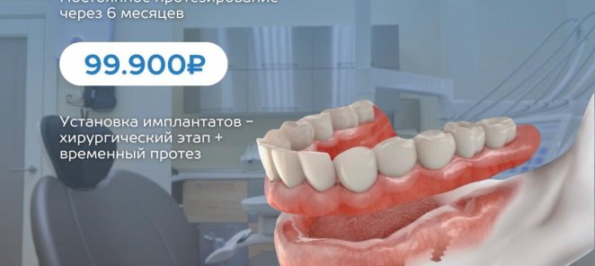 Имплантация зубов на 4 имплантатах+ протез за 99900