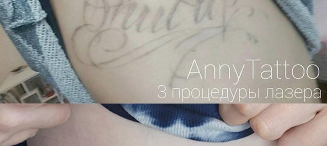 Удаление татуировок в Тату-салоне AnnyTattoo studio от 1500р