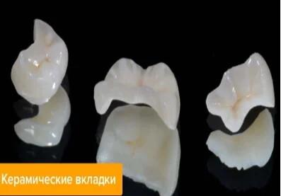 Эстетическая реставрация керамическими вкладками