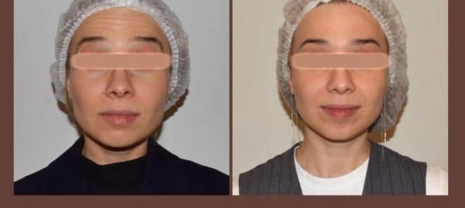Ботулинотерапия Full Face – это не про «заморозку» 💉