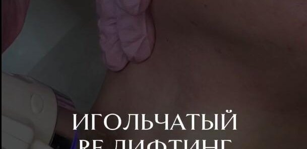 Игольчатый RF-лифтинг