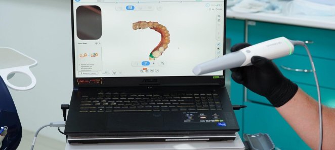 Установка имплантата Osstem - 25000 руб.