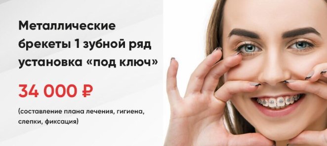 Металлические брекеты 