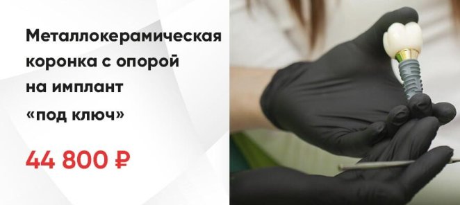 Металлокерамическая коронка с опорой на имплант «под ключ»