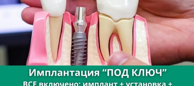 Имплантация «ПОД КЛЮЧ»
