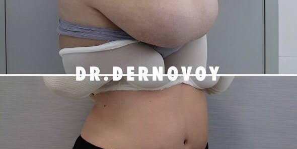 А где рубцы? Или как быстро избавиться от кожаного фартука