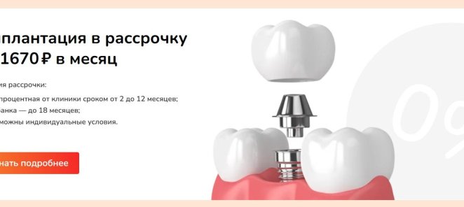Имплантация в рассрочку от 1670р в месяц