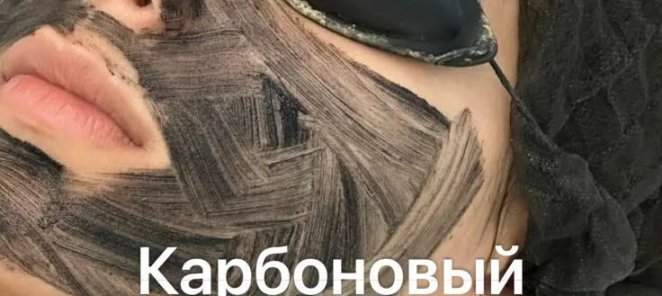Карбоновый пилинг лица – 5 сеансов по выгодной цене!