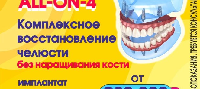 All-ON-4 Все на 4х альтернатива съёмному протезированию