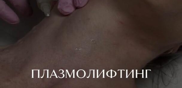 Плазмолифтинг