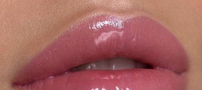 Бьютификация губ филлерами гиалуроновой кислоты