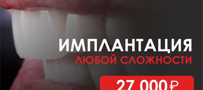 Имплантация зубов любой сложности